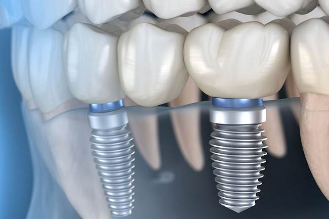 servizio implantologia