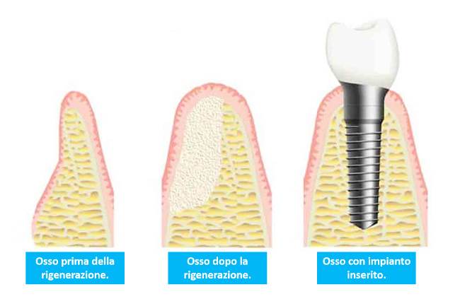 Rigenerazione Ossea
