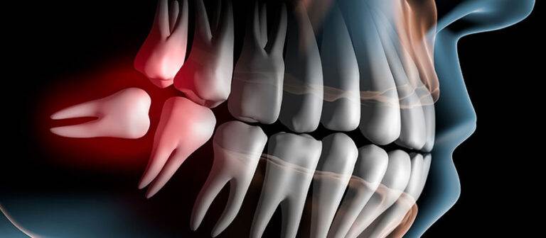 dente giudizio 914 400