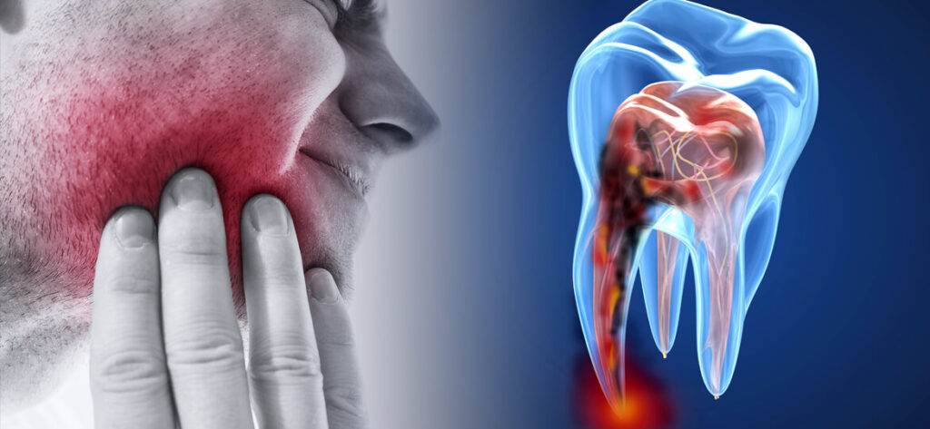 devitalizzazione dente 1